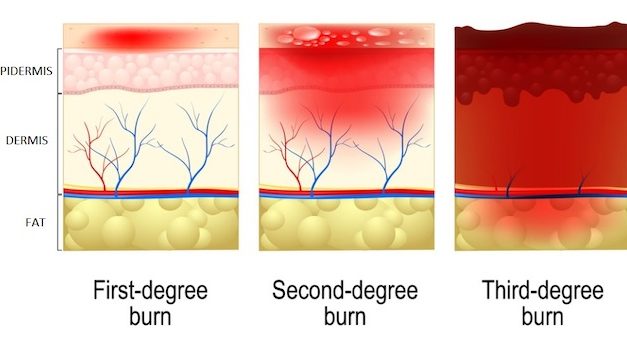 Vanderbilt Researches Autoimmune Drug for Preventative Burn Treatment